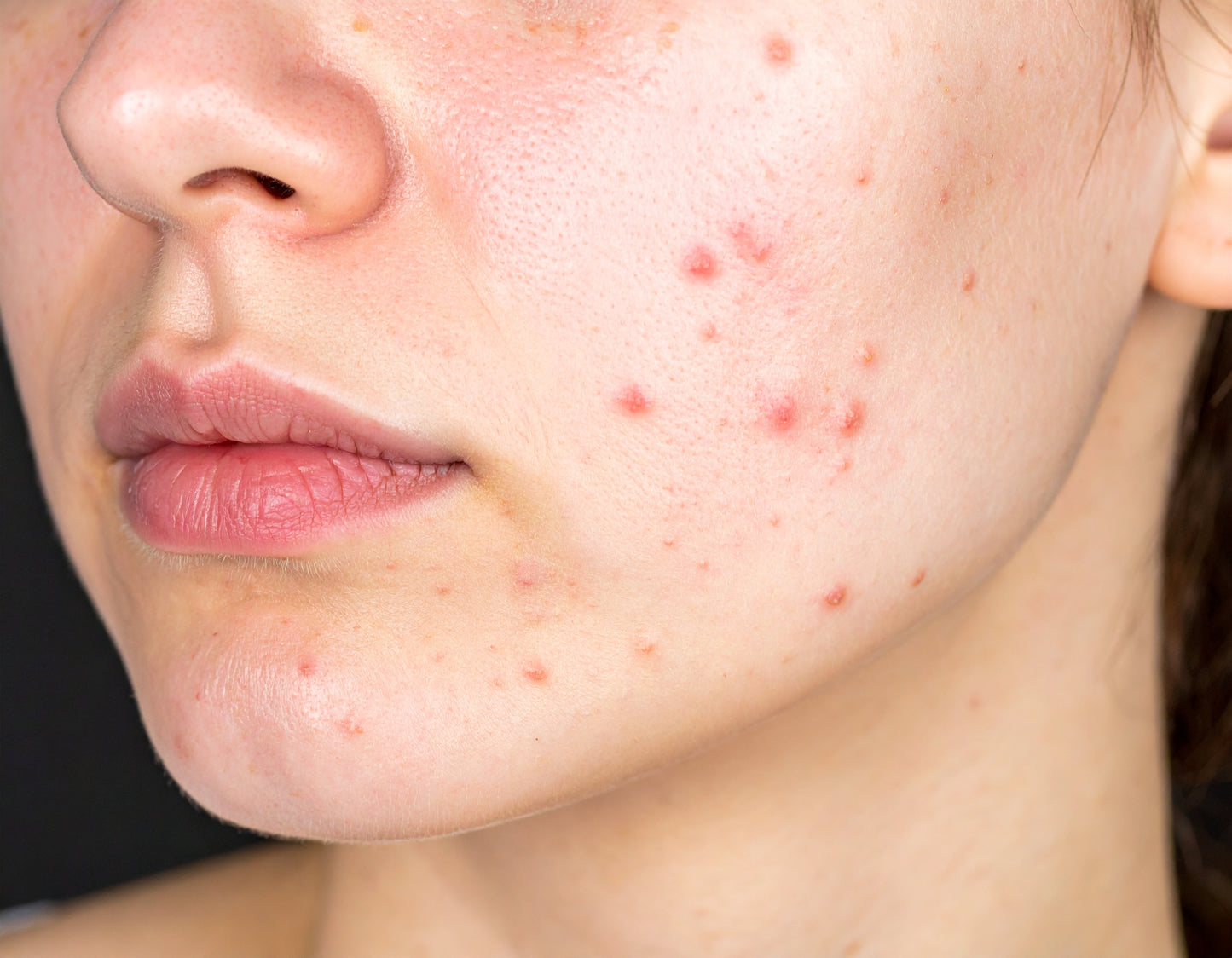 Acne pimple kit