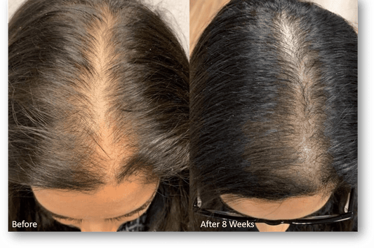 Hairfall kit