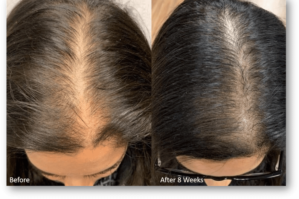 Hairfall kit